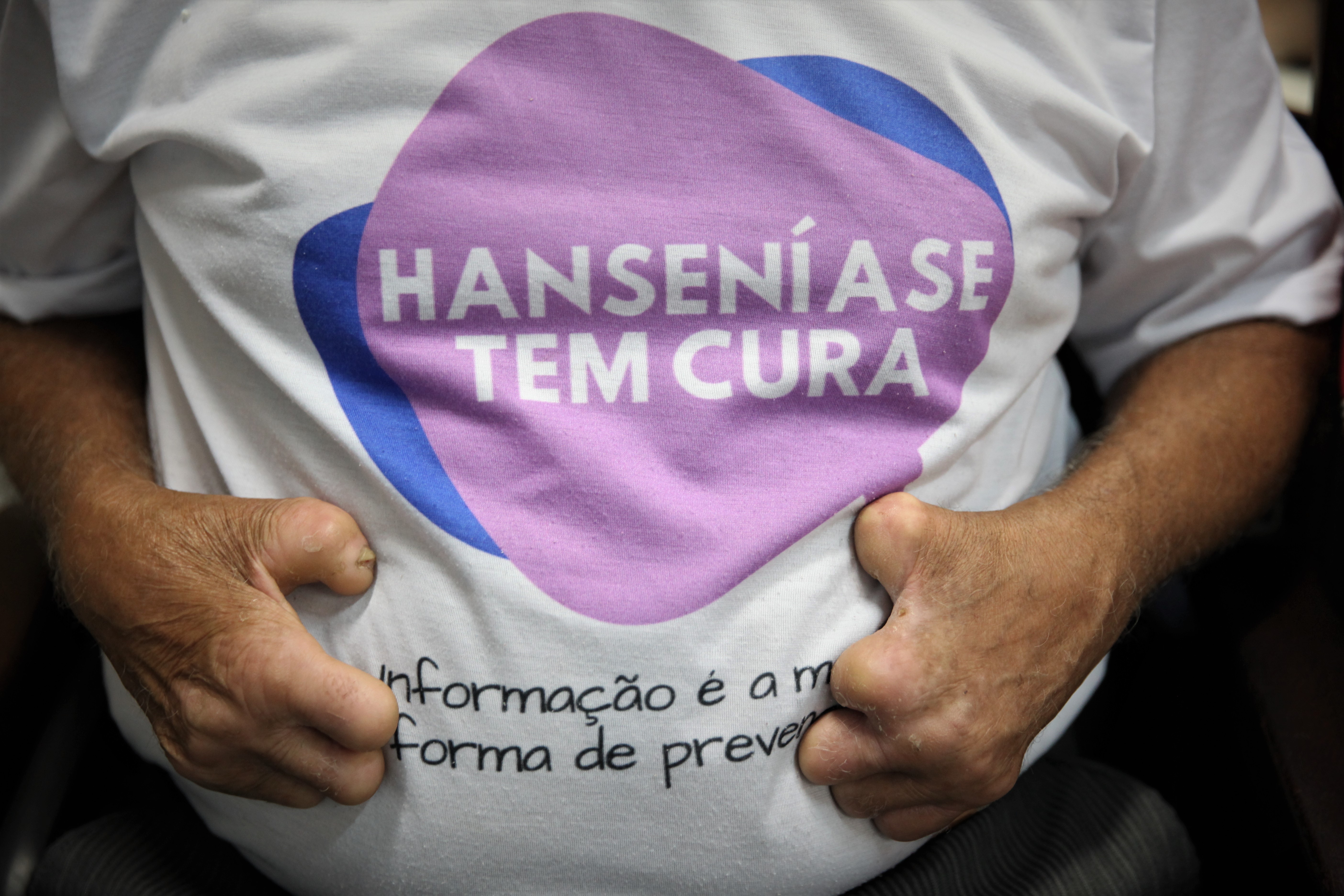 Saúde intensifica ações de prevenção e diagnóstico de hanseníase no Alto Acre